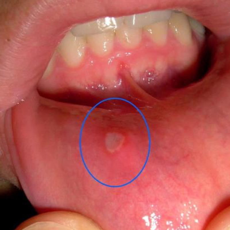 Ist das eine Blase auf der Lippe? (Pickel)