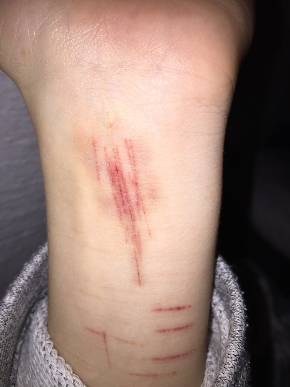 Blutvergiftung wunde Blutvergiftung wunde