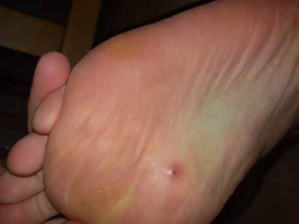 Ist das eine Dornwarze an meiner Fußsohle oder ein Pickel, siehe Bild ...