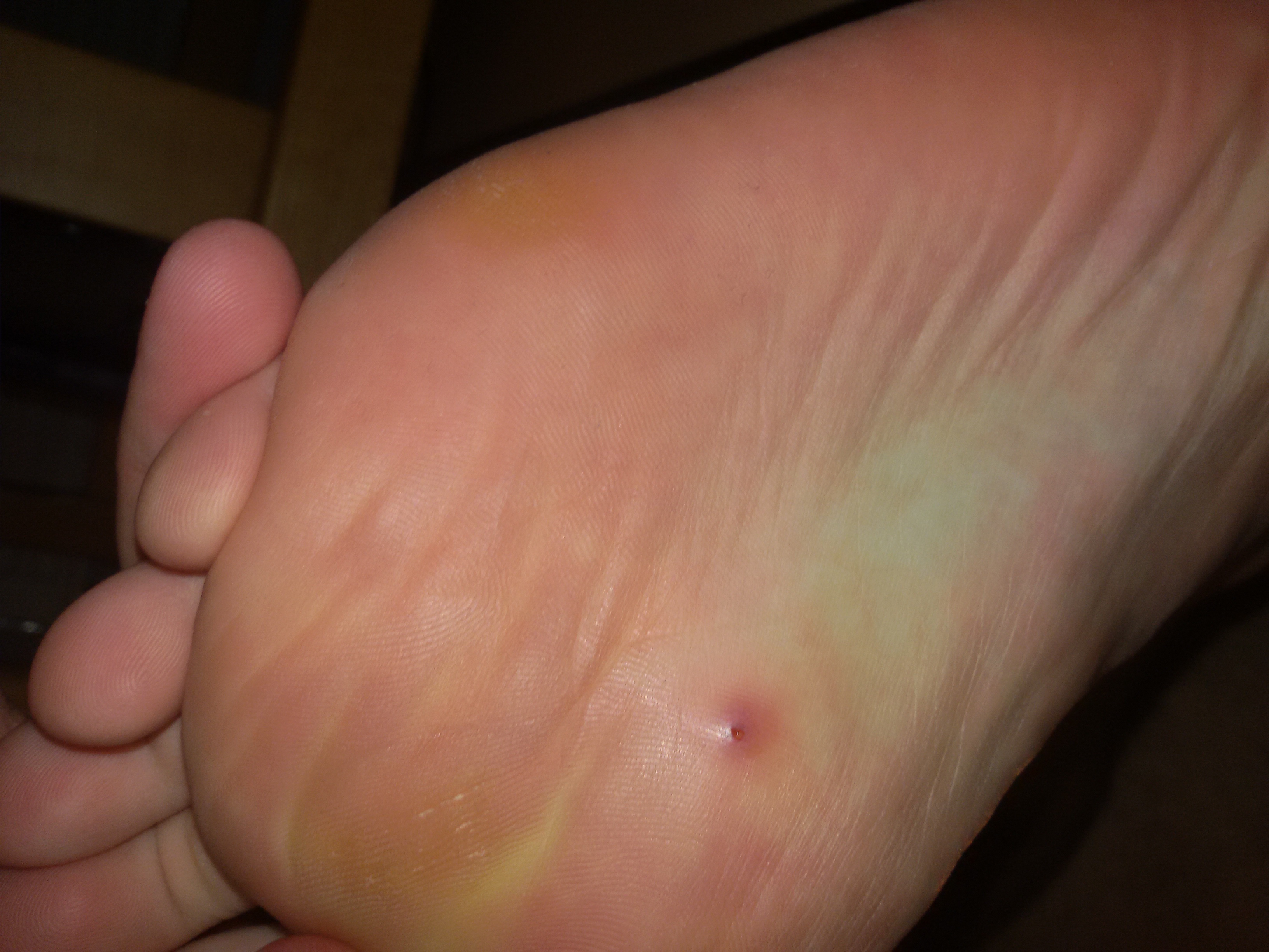 Ist das eine Dornwarze an meiner Fußsohle oder ein Pickel, siehe Bild Ist das eine Dornwarze an meiner Fußsohle oder ein Pickel, siehe Bild