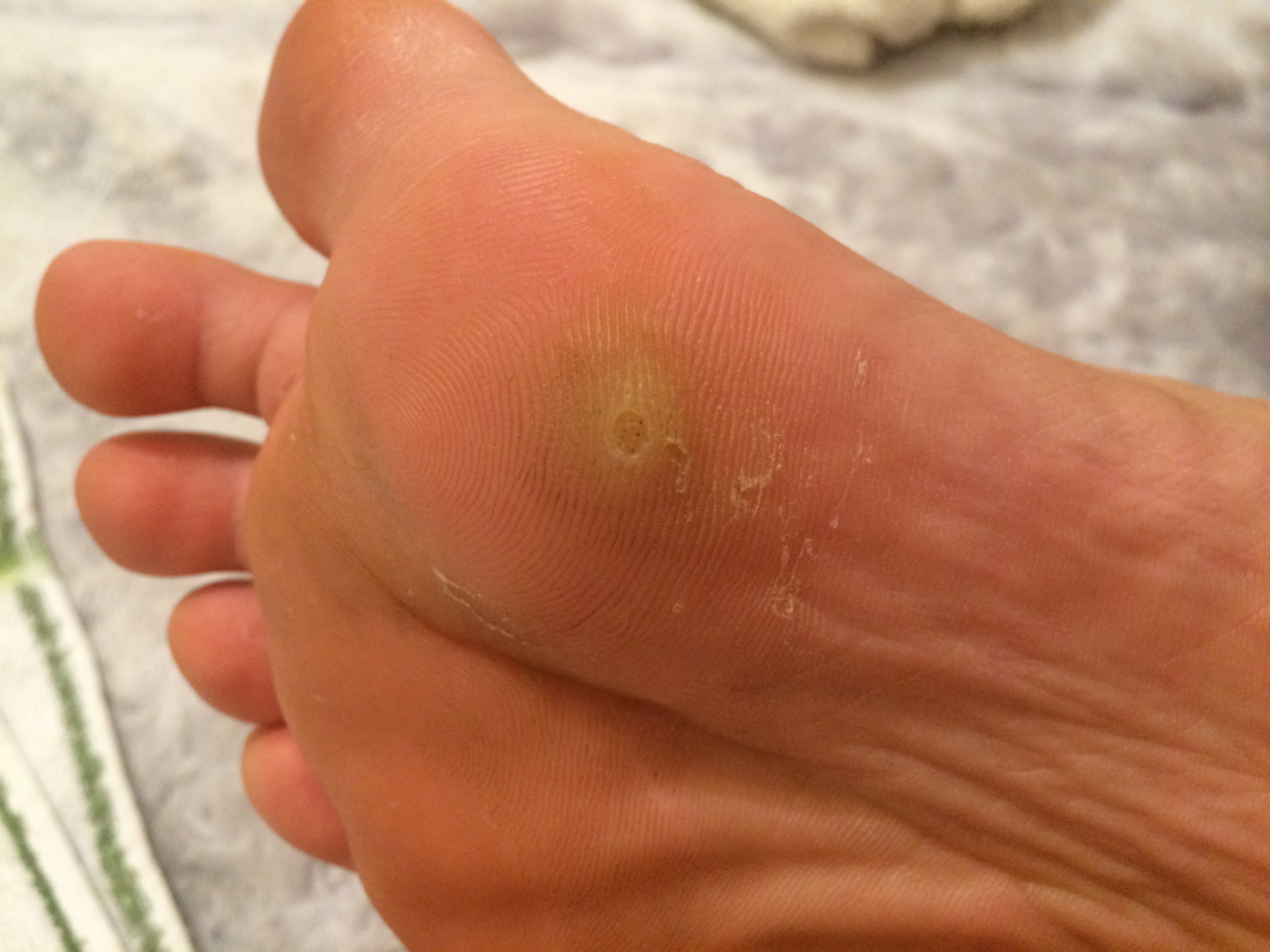 Ist das eine Dornwarze oder ein Hühnerauge? (Warzen) Ist das eine Dornwarze oder ein Hühnerauge? (Warzen)