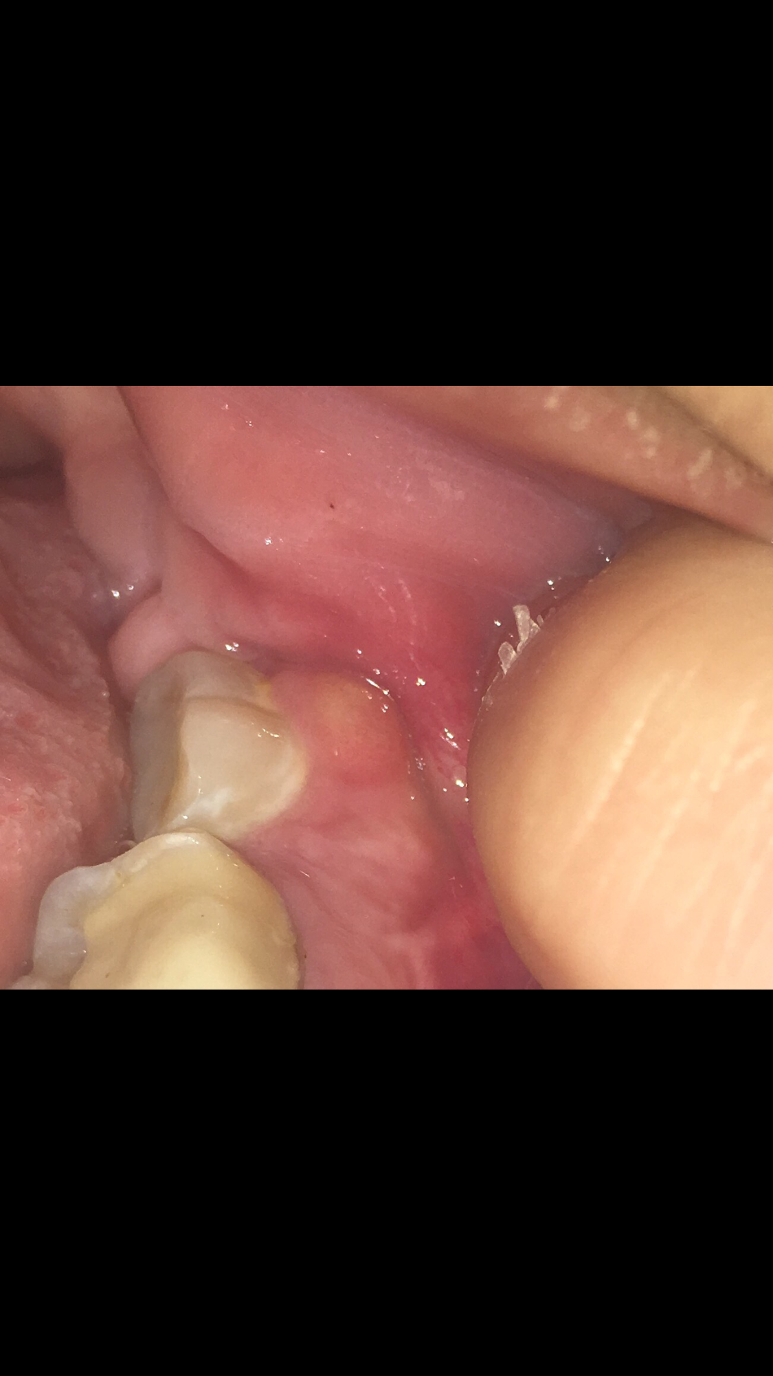 Ist Das Eine Eiter Beule Gesundheit Zahne Ist Das Eine Eiter Beule Gesundheit Zahne