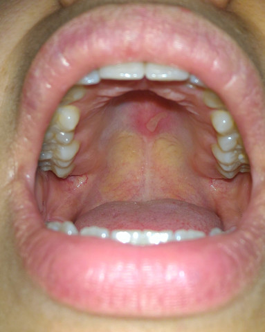 Ist das eine Entzündung im Mund? (Arzt, Medikamente, Krankenhaus)