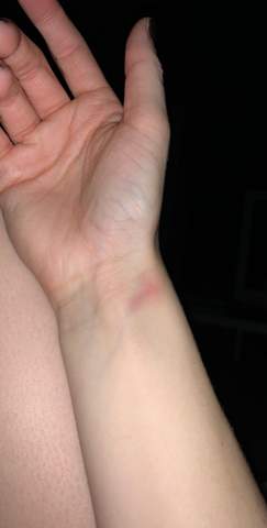 Ist Das Eine Geplatzte Ader Oder Was Kann Das Sein Gesundheit Und Medizin Gesundheit Krank Ist Das Eine Geplatzte Ader Oder Was Kann Das Sein Gesundheit Und Medizin Gesundheit Krank