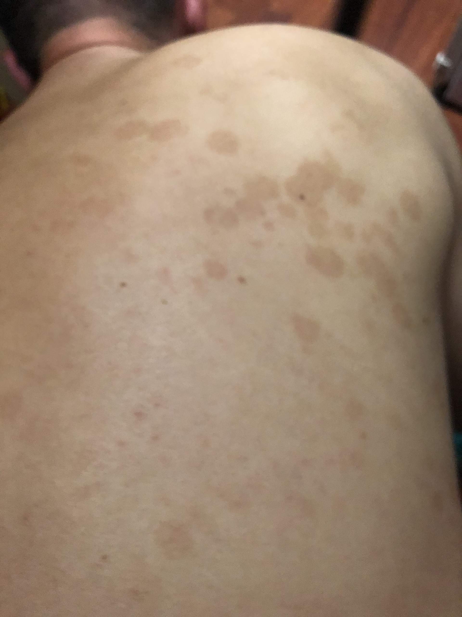 Ist das eine geschlechtskrankheit (HPV)? (Krankheit, Haut, Hautkrankheit)