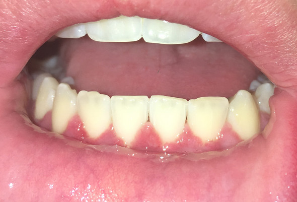 Ist das eine grosse zahnfleisch entzündung? (Zähne, Zahnarzt, behandeln)