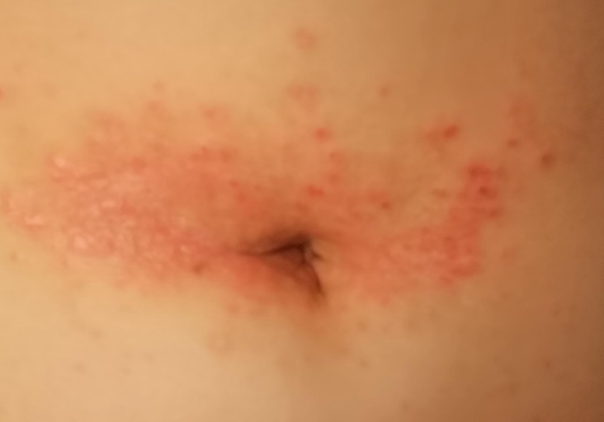 Ist das eine Gürtelrose oder was anderes? (Gesundheit und Medizin