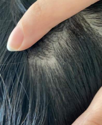 ist das eine kahle stelle haarausfall alopecia areata
