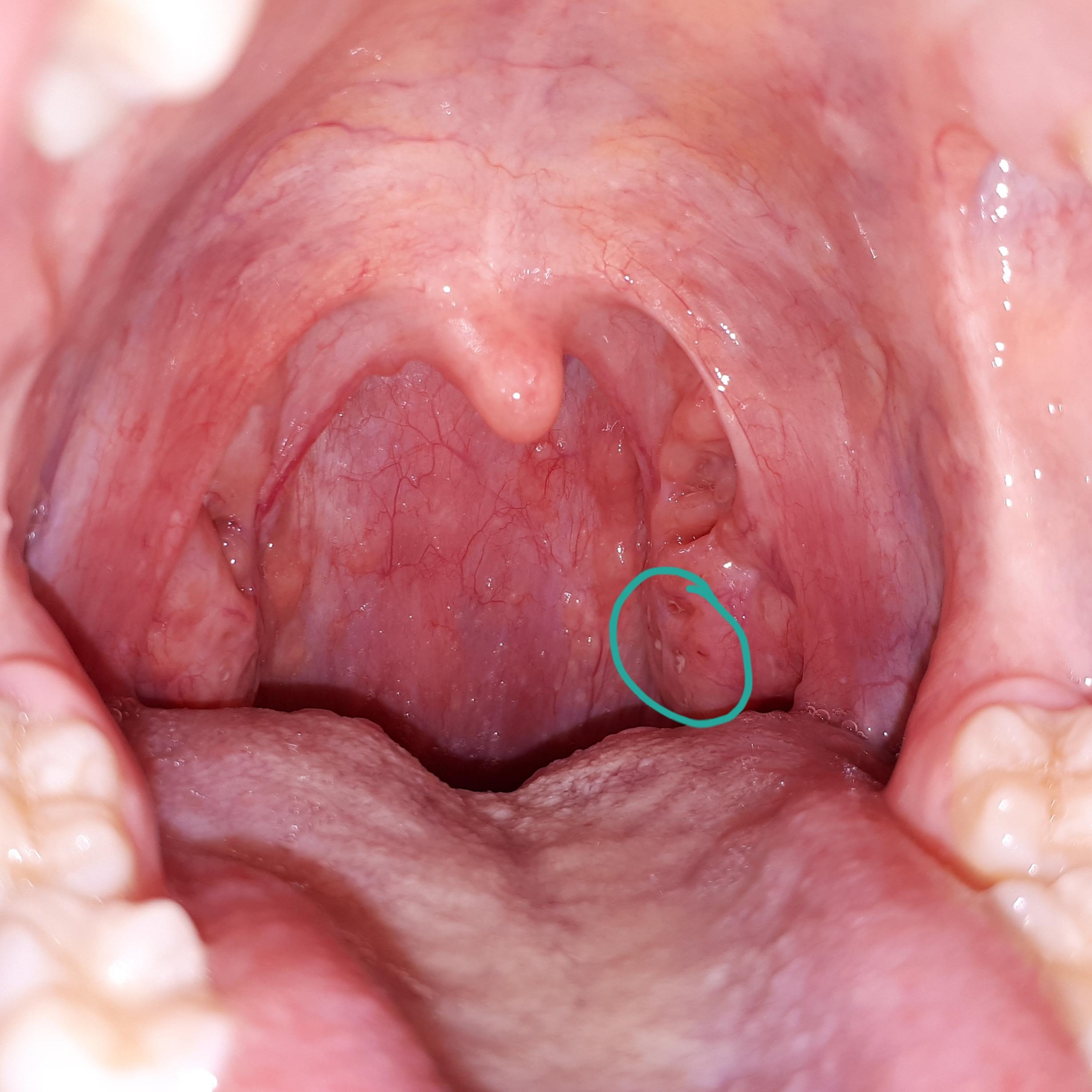 Ist das eine Mandelentzündung oder nicht? (Gesundheit, Gesundheit und Ist das eine Mandelentzündung oder nicht? (Gesundheit, Gesundheit und