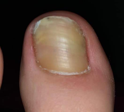 ist das eine nagelkrankheit oder ein blauer fleck gesundheit und medizin flecken