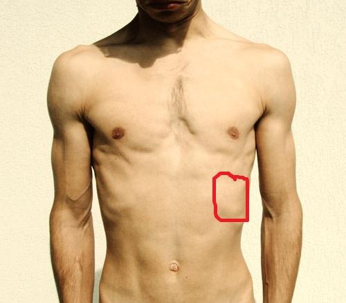 Ist das eine Rippenfellentzündung? (Schmerzen, Entzündung, rippen)