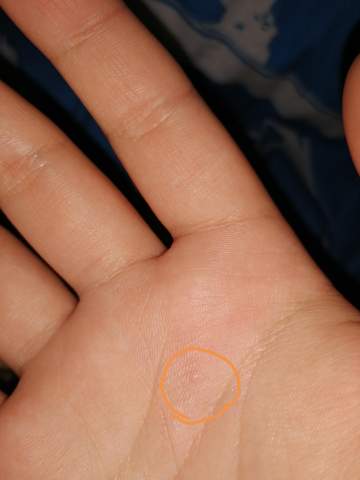 Ist Das Eine Warze An Der Hand Warzen Ist Das Eine Warze An Der Hand Warzen