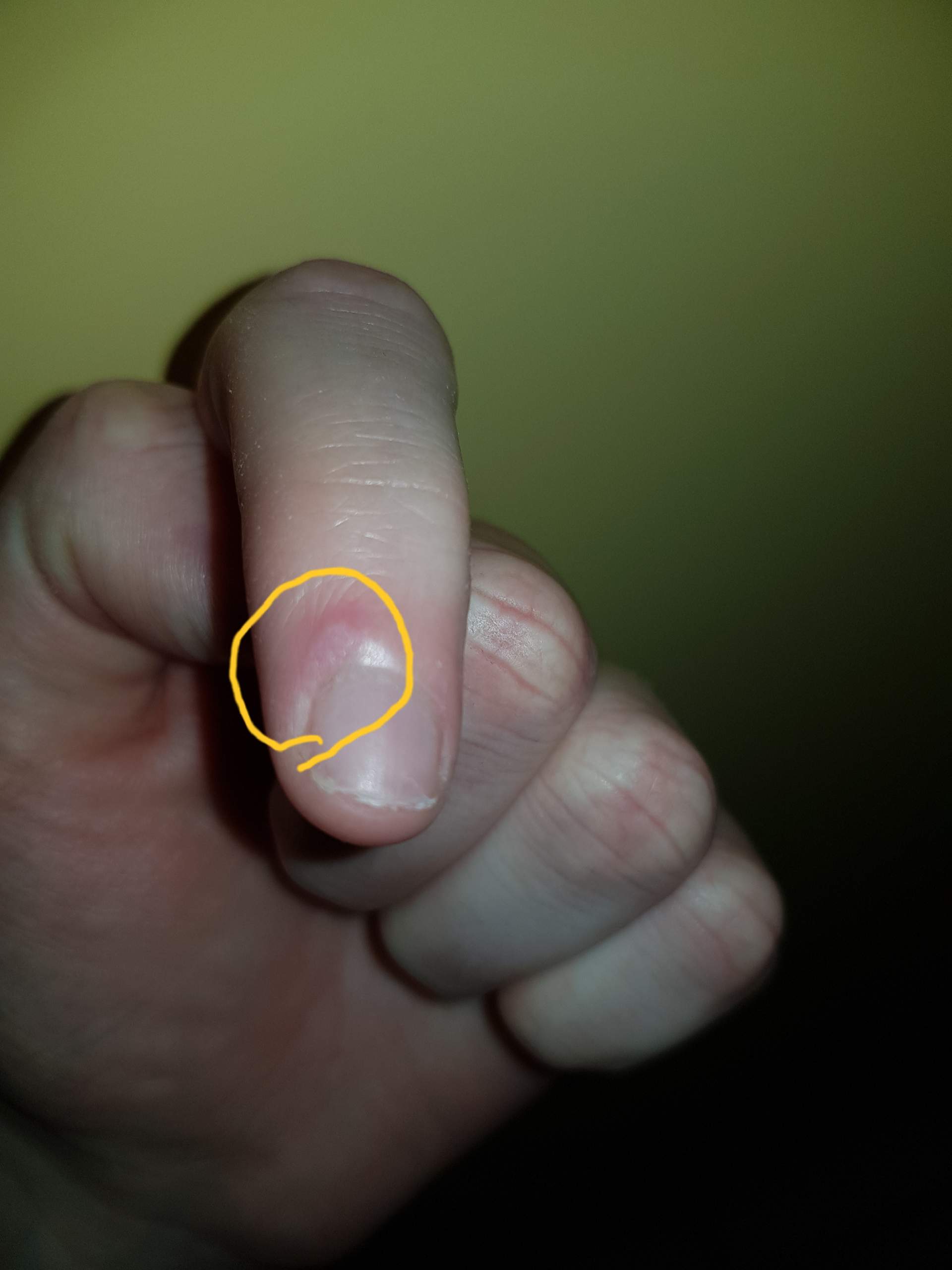 Ist das eine Warze an meinem Finger oder eher eine Entzündung am Fingernagel?? (Gesundheit und ...