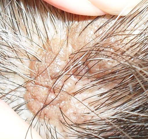 Ist Das Eine Warze Auf Dem Kopf Warzen Kopfhaut Ekzem Ist Das Eine Warze Auf Dem Kopf Warzen Kopfhaut Ekzem