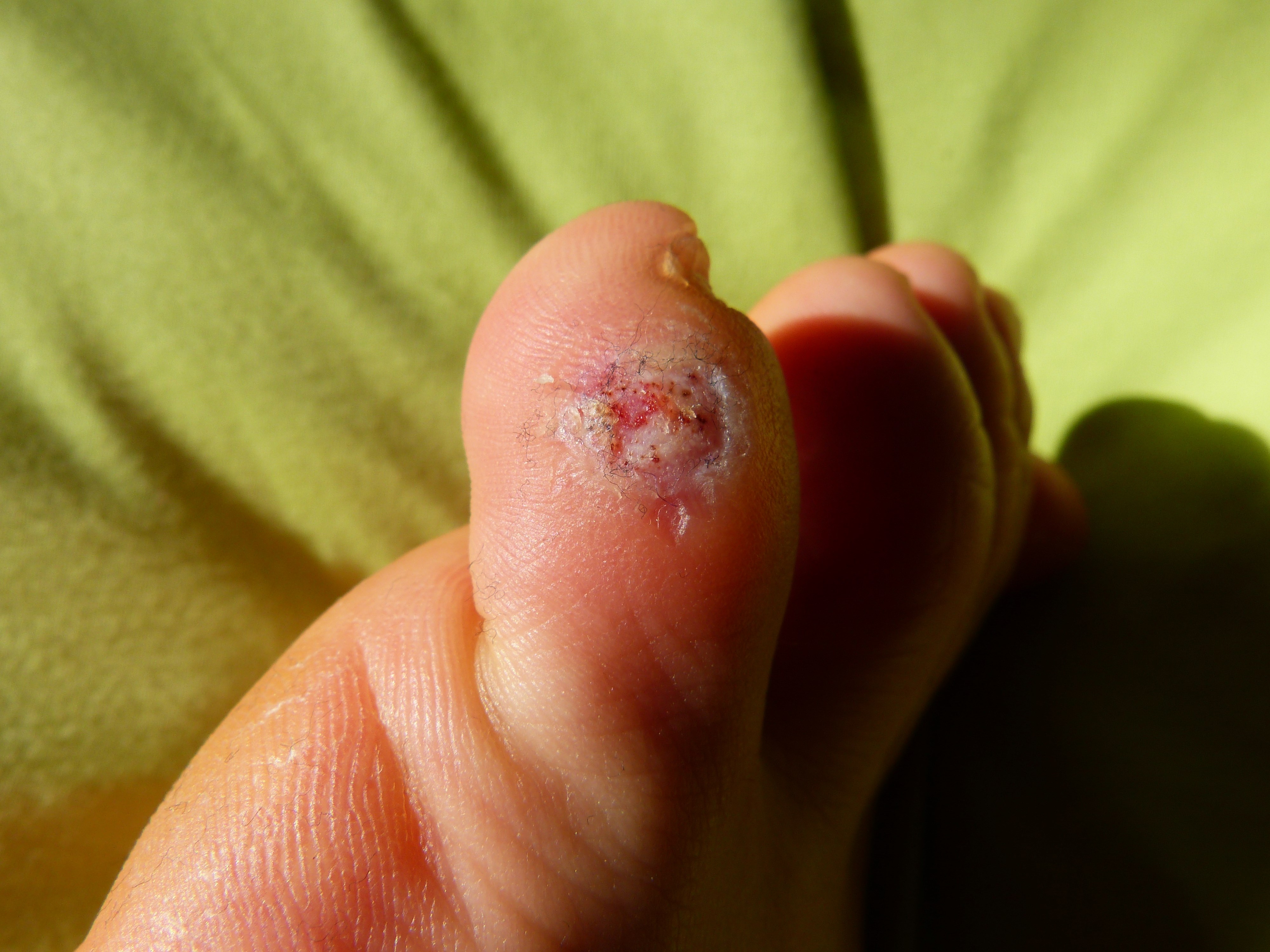 Ist das eine Warze oder ein Hühnerauge? (Gesundheit, Füße, Zeh) Ist das eine Warze oder ein Hühnerauge? (Gesundheit, Füße, Zeh)