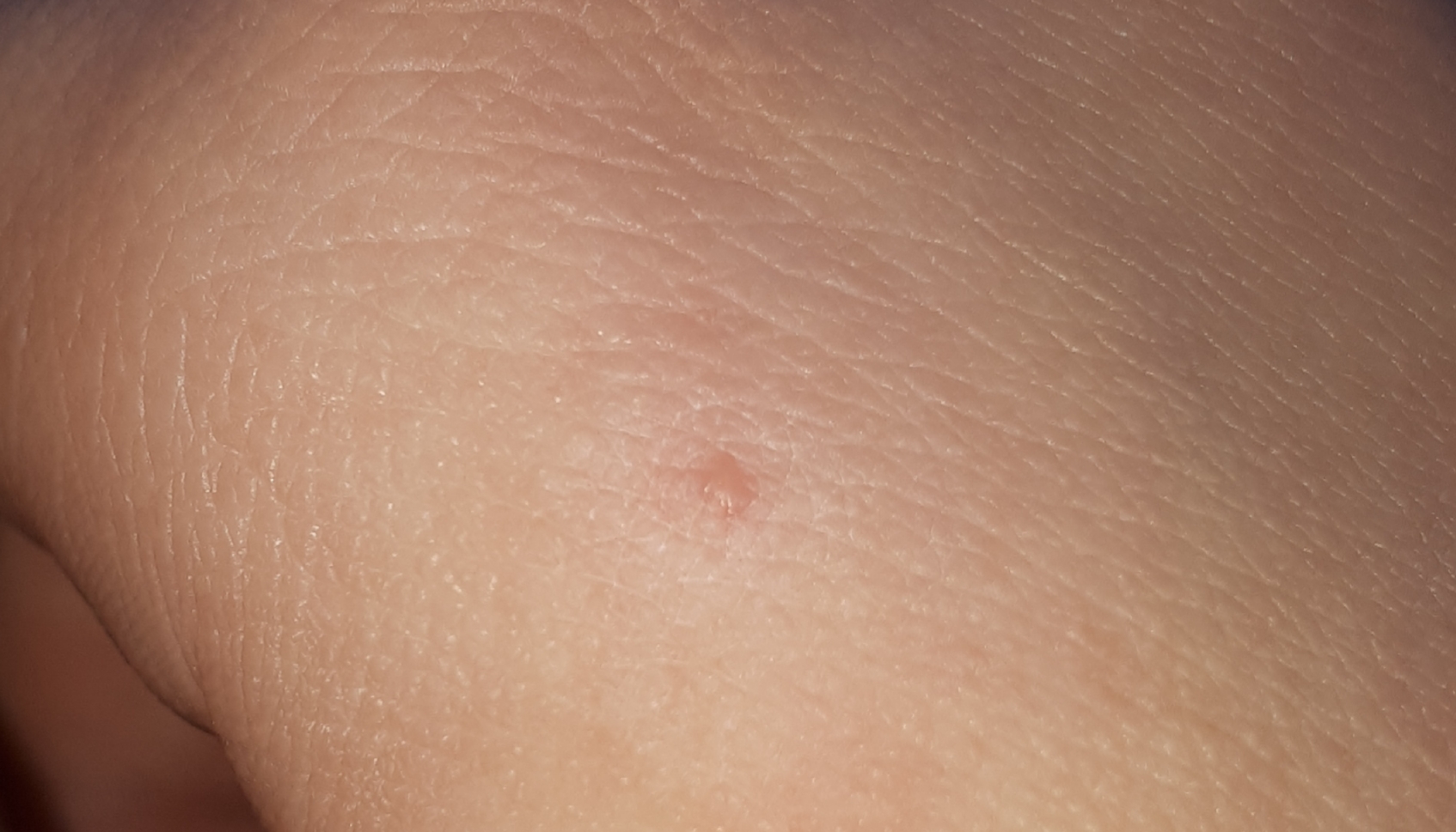 Ist das eine Warze oder was anderes? (Haut, Warzen, Warzenbehandlung) Ist das eine Warze oder was anderes? (Haut, Warzen, Warzenbehandlung)