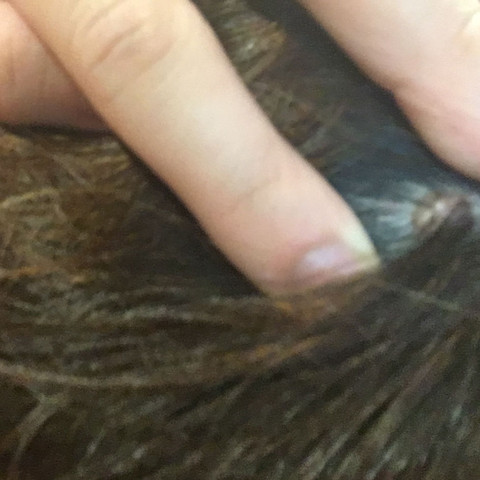 Ist Das Eine Warze 1 Entfernen Hautarzt Warzen Ist Das Eine Warze 1 Entfernen Hautarzt Warzen