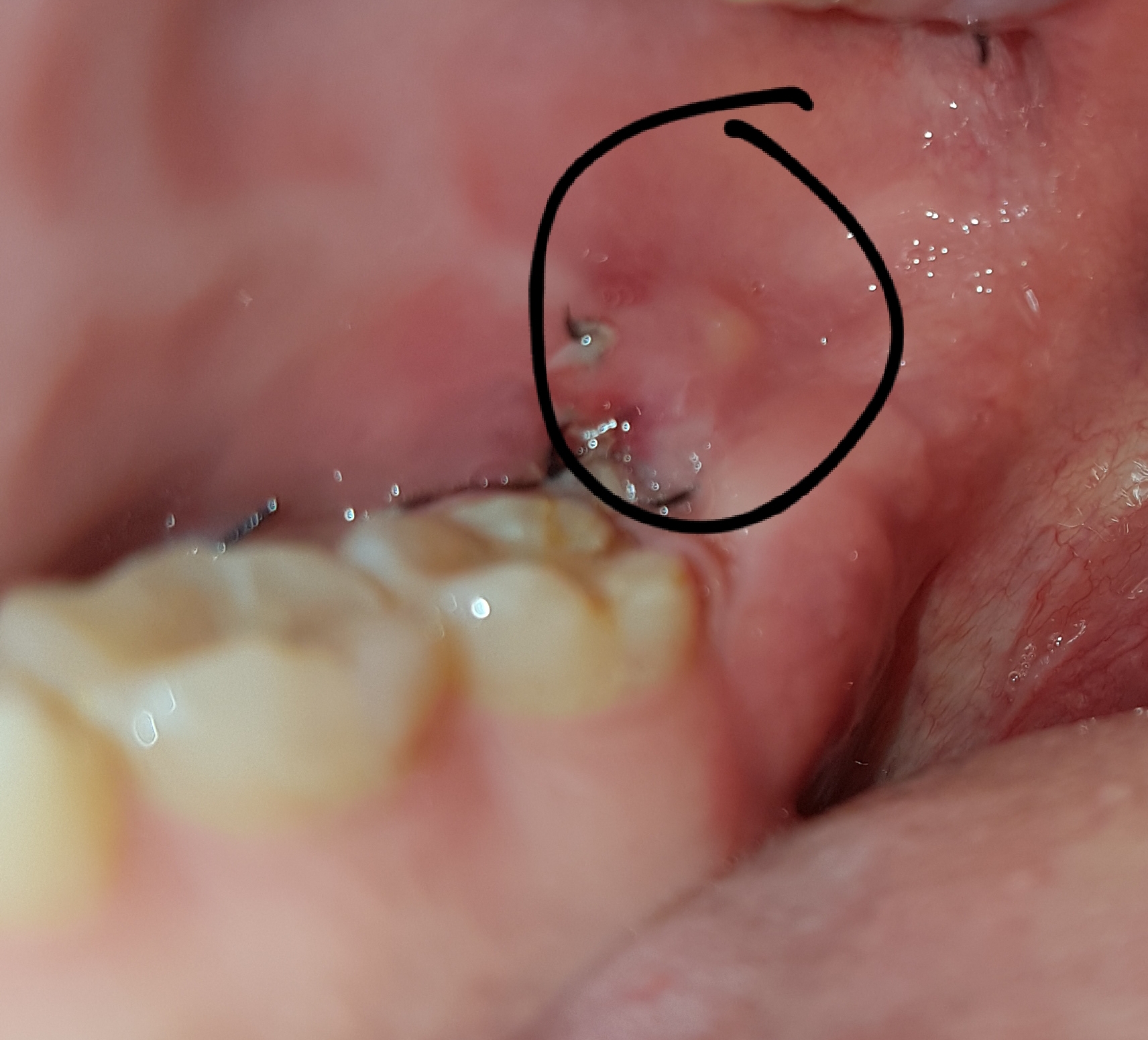 Weisheitszahn Op Wunde Blutet Nach 5 Tagen Ist das eine weisheitszahn op entzündung hilfeee ? (Arzt, Zahnarzt, Rat)