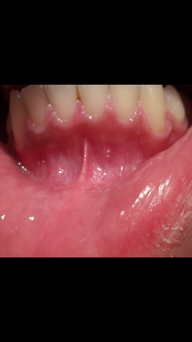 Pocht zahnfleisch Druckschmerz Zähne