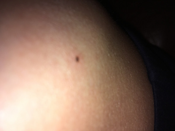 Ist Das Eine Zecke Bin Mir Nicht Sicher Gesundheit