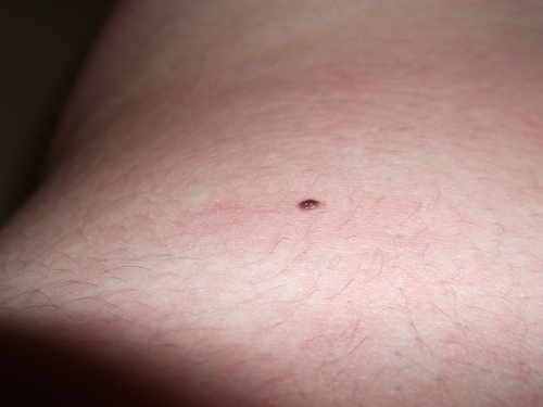 Ist das eine Zecke oder ein Muttermal? (Gesundheit)