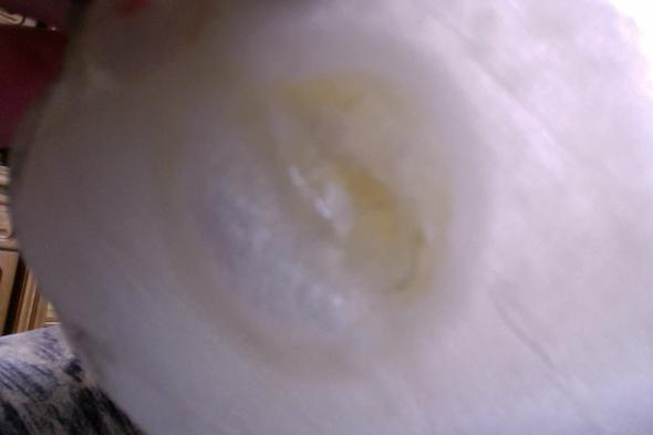 Blase - (Medizin, Blase)