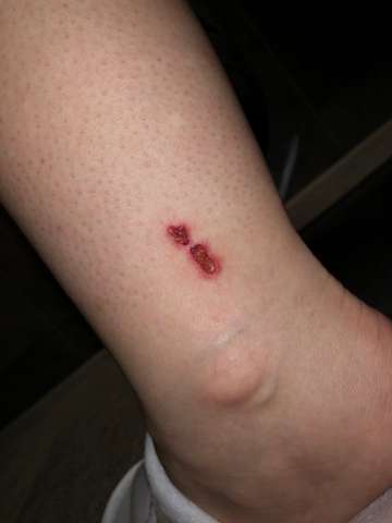 Ist Das Entzundet Ja Oder Nein Gesundheit Medizin Ist Das Entzundet Ja Oder Nein Gesundheit Medizin