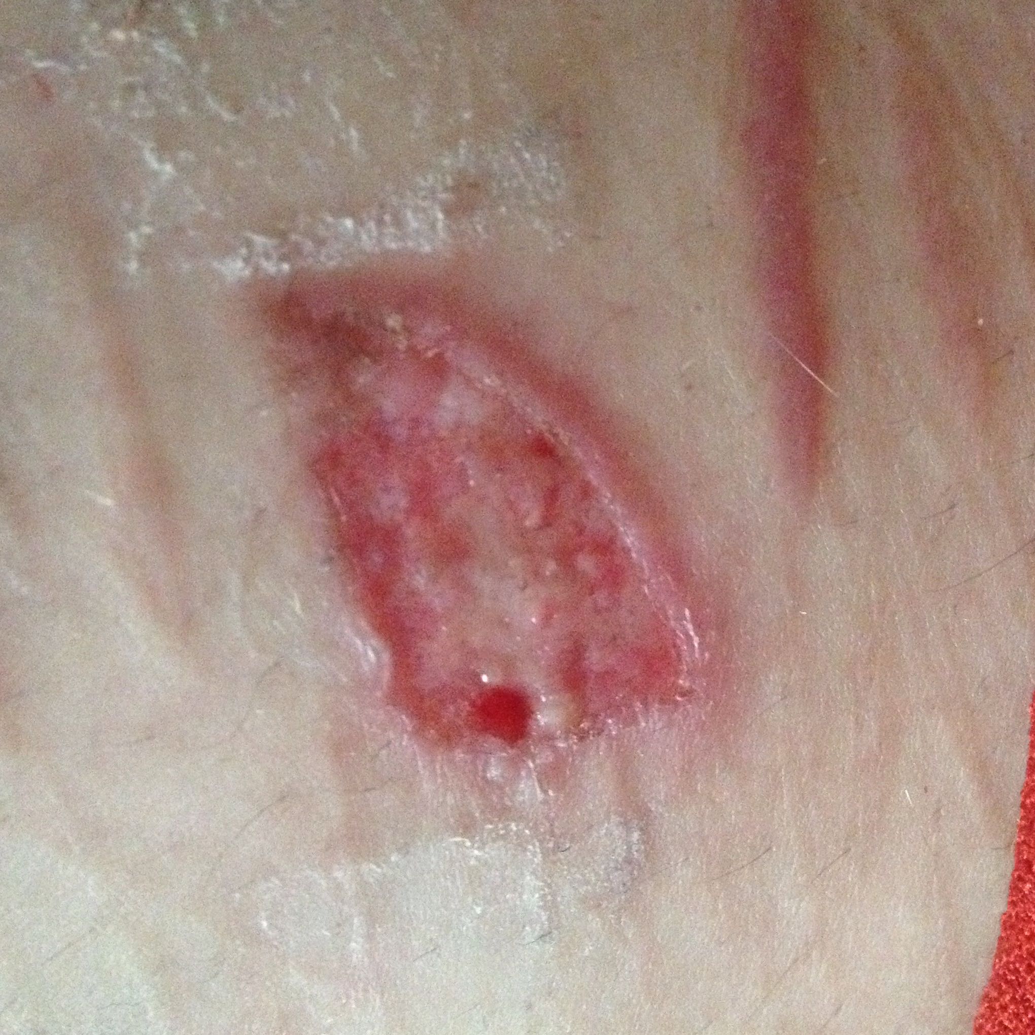 Ist das entzündet (verbrennung)? (Medizin, Verletzung, Wunde)