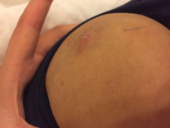 Ist Das Etwa Brustkrebs Gesundheit Und Medizin Gesundheit Medizin Ist Das Etwa Brustkrebs Gesundheit Und Medizin Gesundheit Medizin