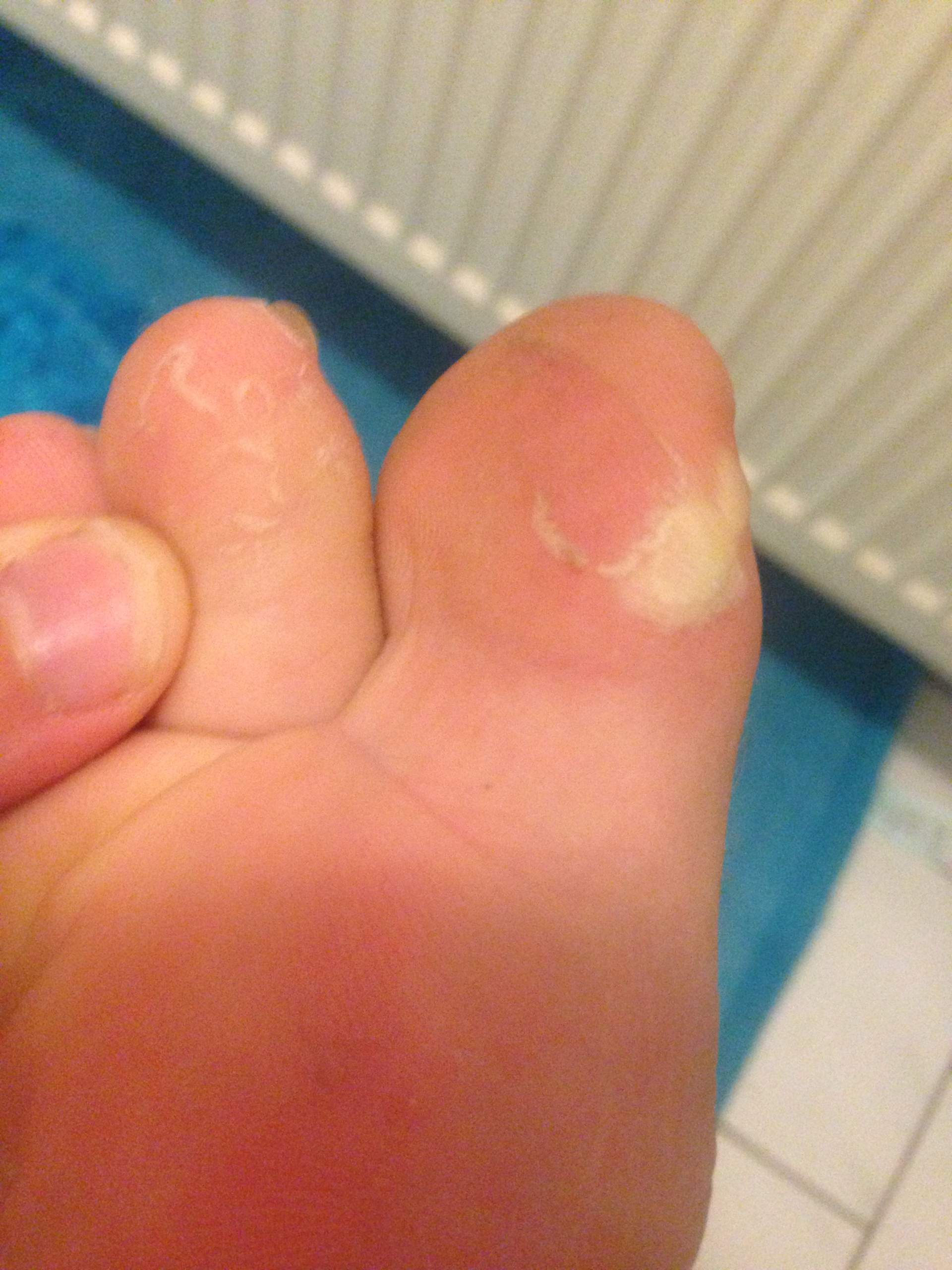 Ist Das Fusspilz Medizin Korper Krankheit Ist Das Fusspilz Medizin Korper Krankheit