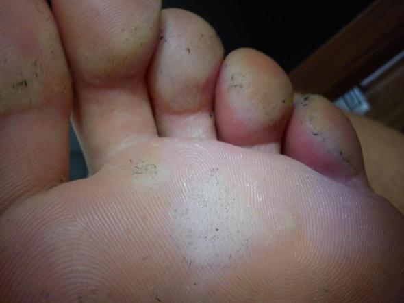 Ist Das Fusspilz Ich Bitte Um Hilfe Krankheit Fusse Pilze Ist Das Fusspilz Ich Bitte Um Hilfe Krankheit Fusse Pilze