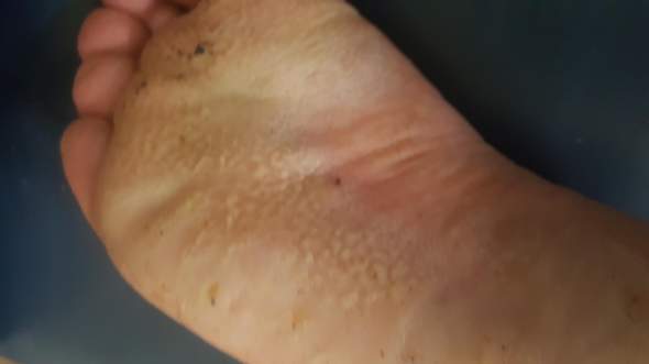 Ist das Fußpilz oder eine andere Hautkrankheit?