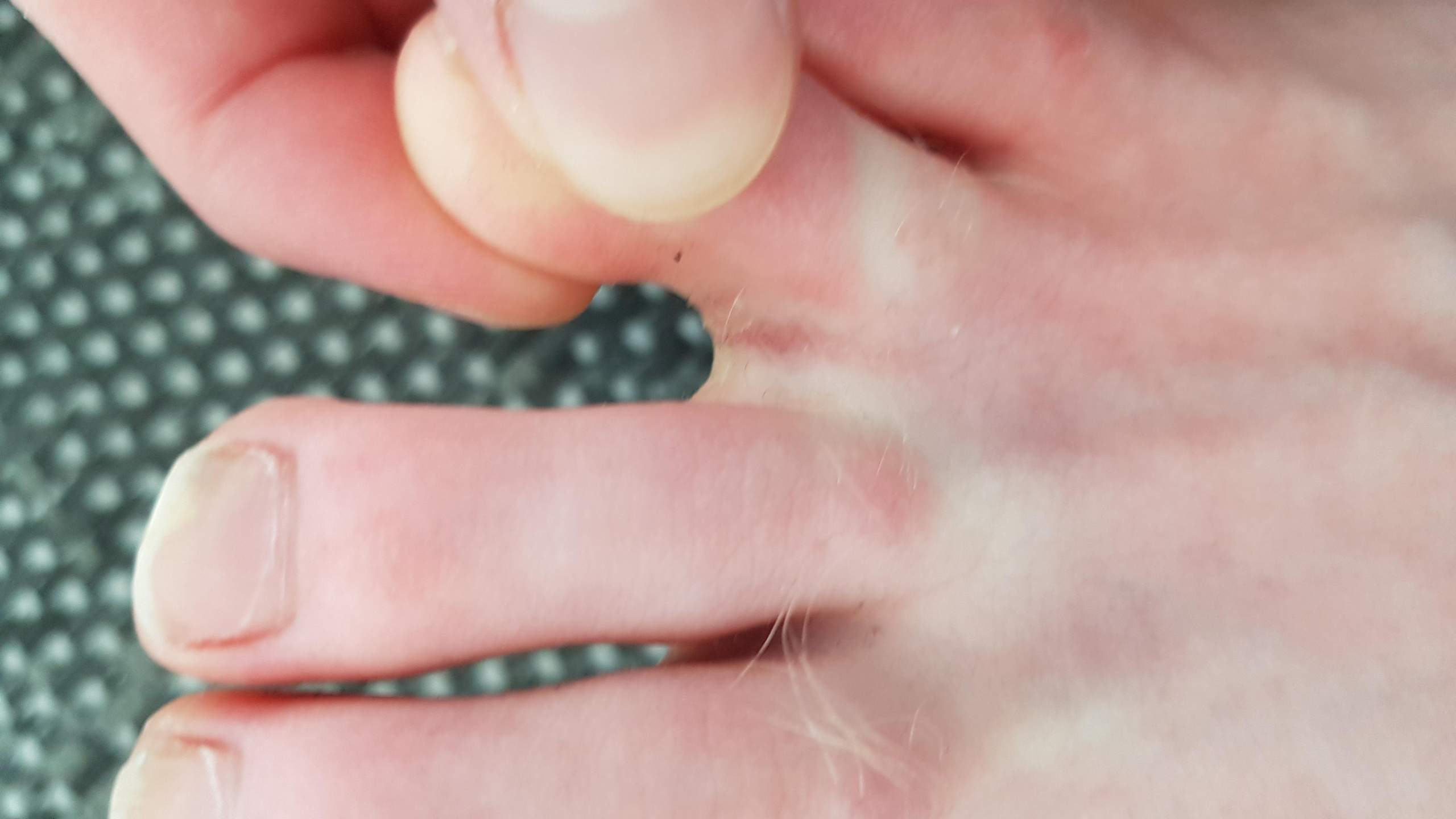 Ist das Fußpilz?Juckt sehr selten mal aber nur schwach ,ist an 3 ...