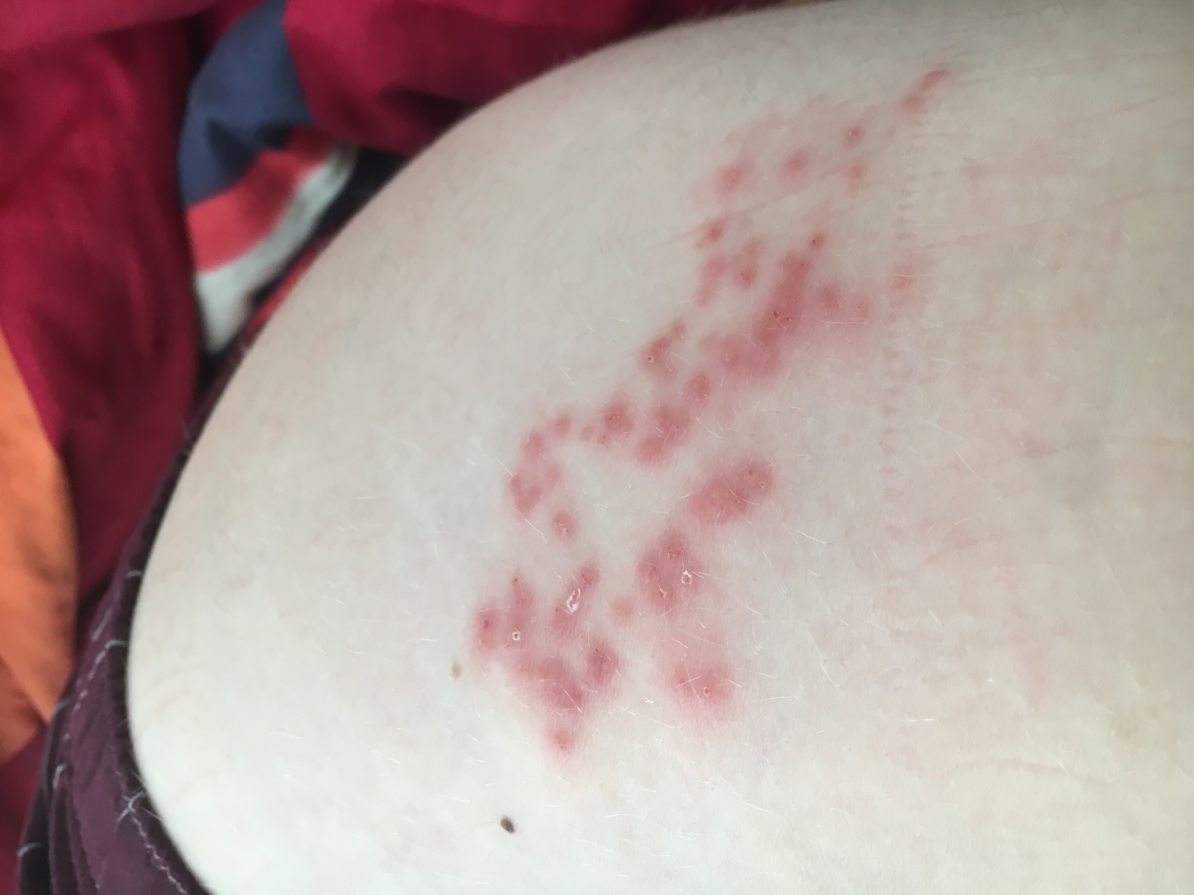 Ist das Gürtelrose bitte helft mir? (Medizin, Ausschlag)