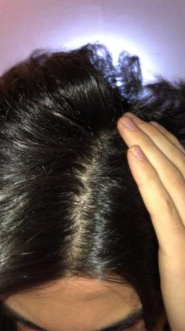 Ist Das Haarausfall Hilfee Gesundheit Haare Beauty