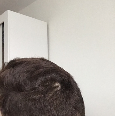 ist das haarausfall oder bilde ich mir