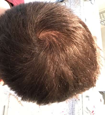 Ist Das Haarausfall Oder Normalll Haare Haarausfall Mit 15