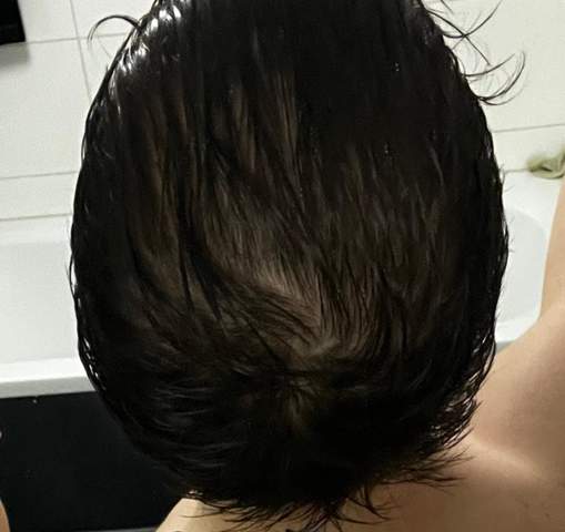 Ist das Haarausfall oder nur dünnes Haar?