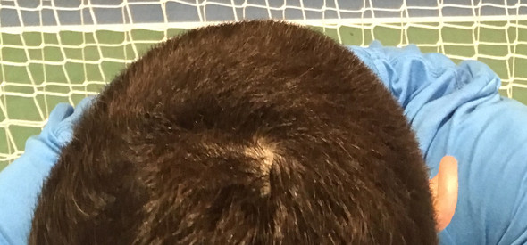 Haarausfall forum frauen