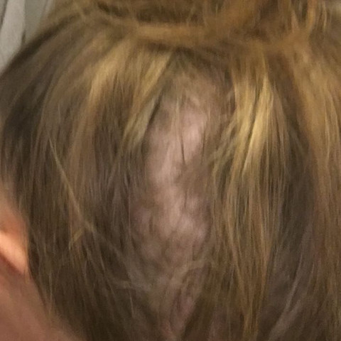 Ist das Haarausfall oder was anderes oder was schlimmes?