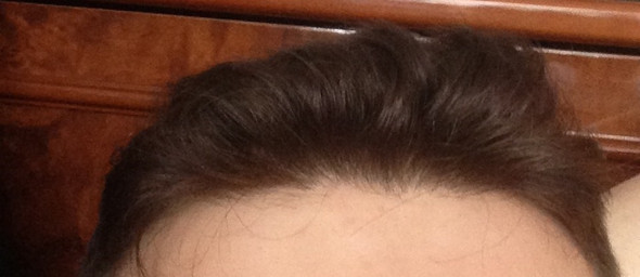 Ist Das Haarausfall Bild Mann Gesundheit Harre