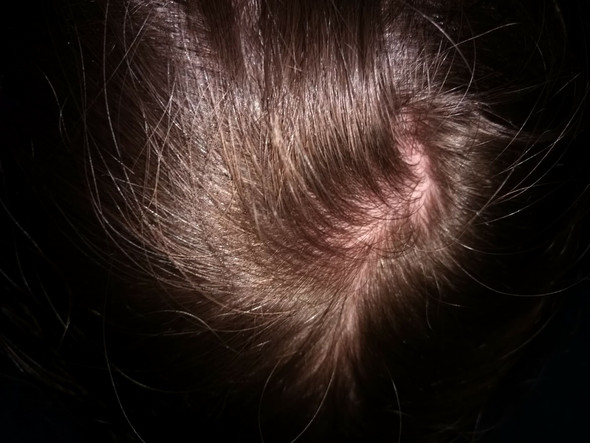 Ist Das Haarausfall Mit Bild Haare Hormone Kopfhaut