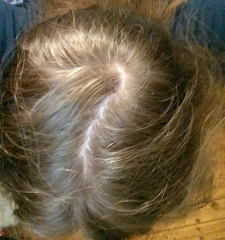 ist das haarausfall mit bild haare