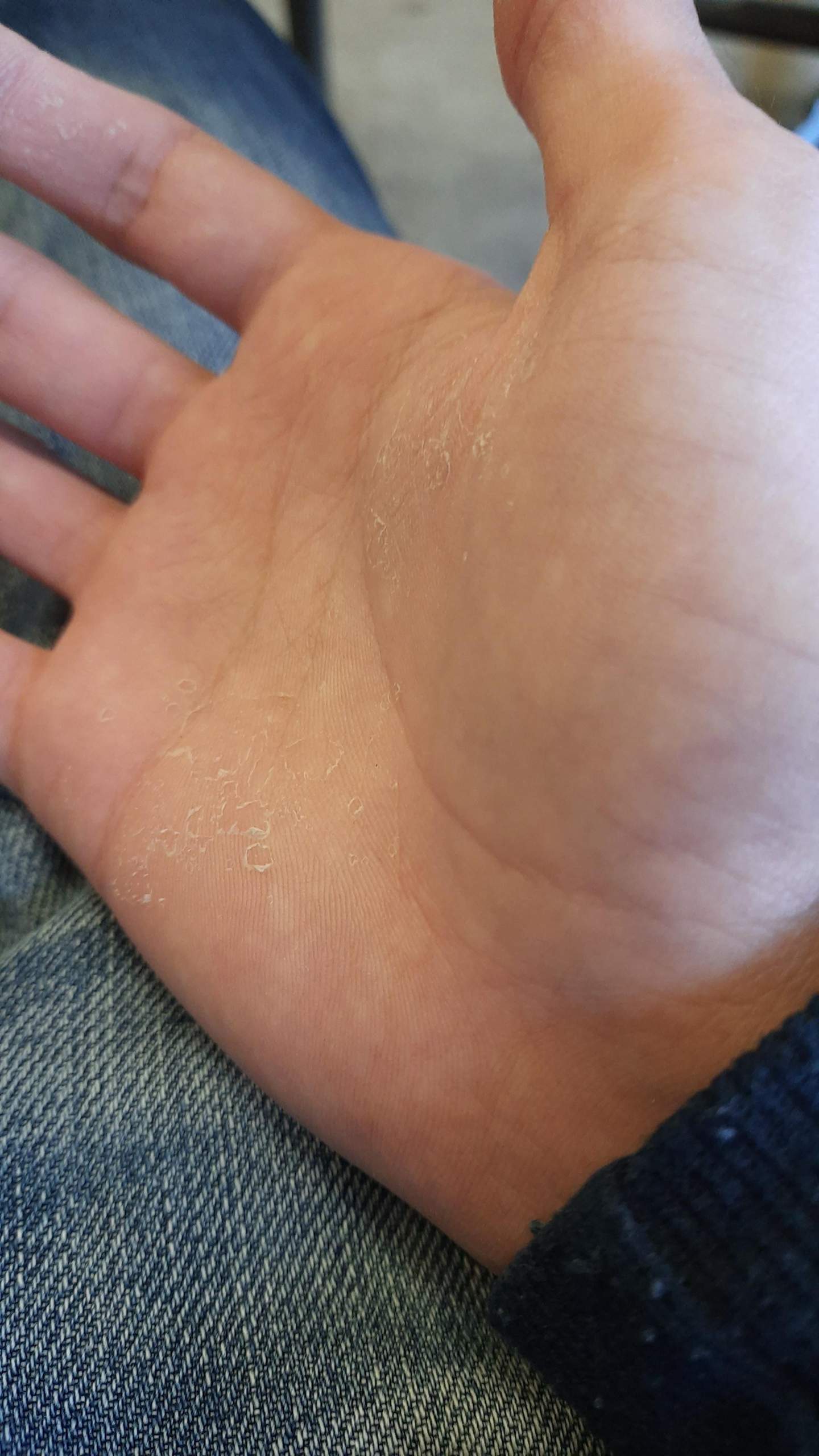 hand pilz oder ekzem bilder