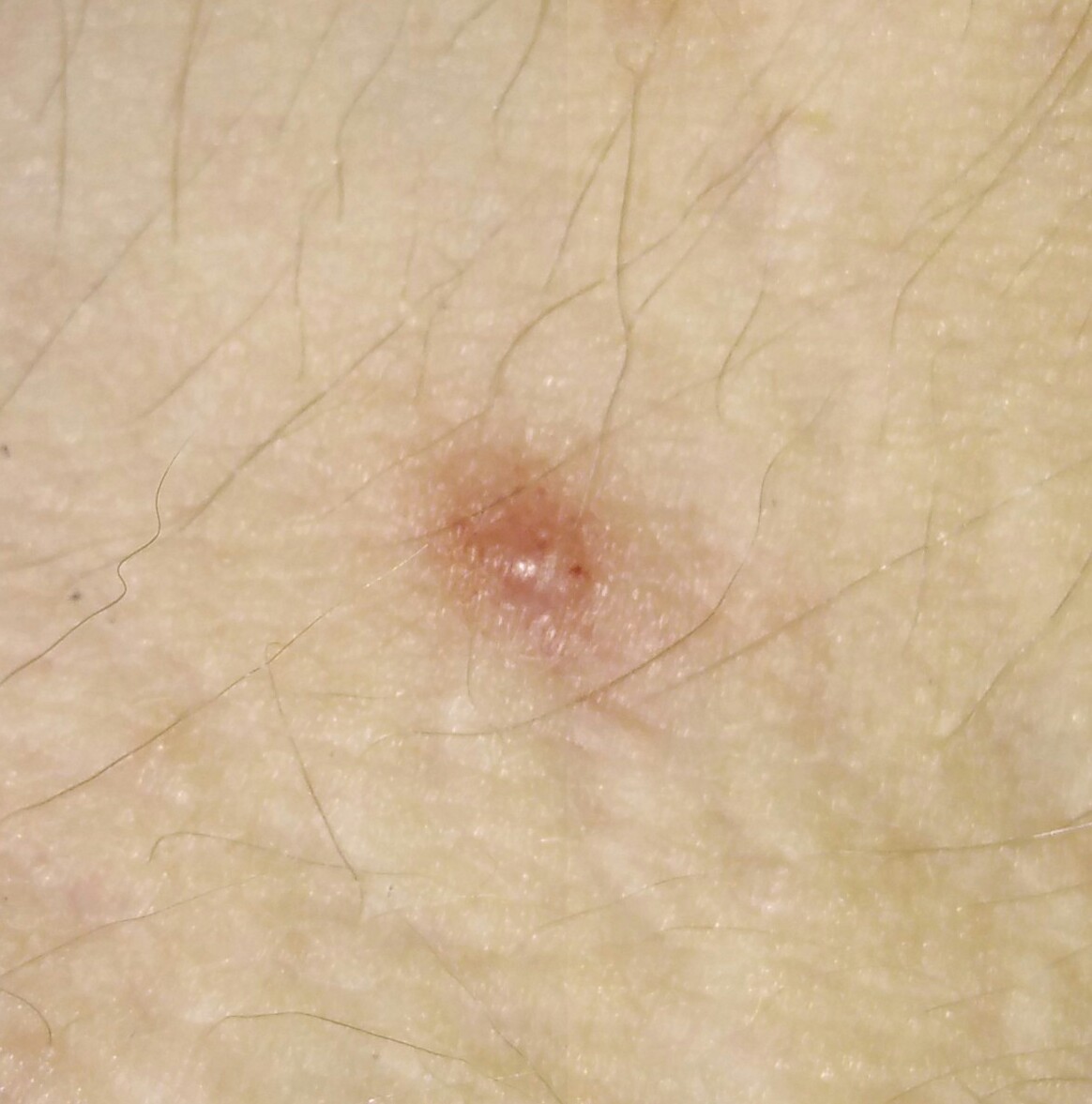 Ist das Hautkrebs, oder harmlos? (Gesundheit, Medizin)