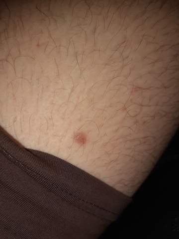 Ist Das Hautkrebs Oder Was Konnte Dieser Fleck Bedeuten Gesundheit Angst Krebs Ist Das Hautkrebs Oder Was Konnte Dieser Fleck Bedeuten Gesundheit Angst Krebs