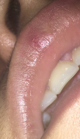 - (Gesundheit und Medizin, Lippe, Herpes)