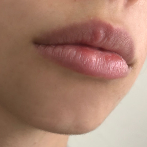 Knubbel auf der Lippe, was ist das ? - (Gesundheit und Medizin, Lippe, Herpes)