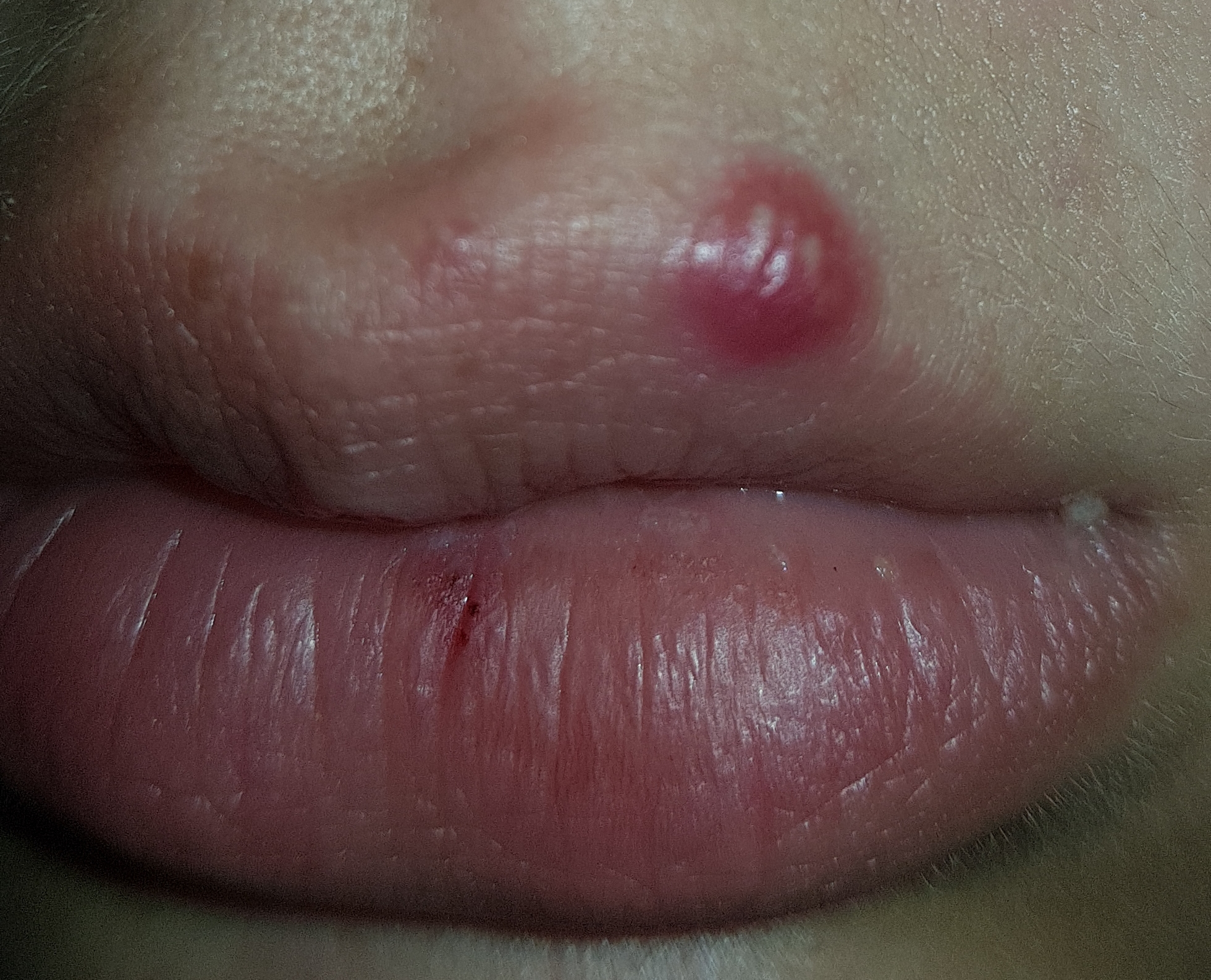 Download Pickel An Der Lippe Oder Herpes Images