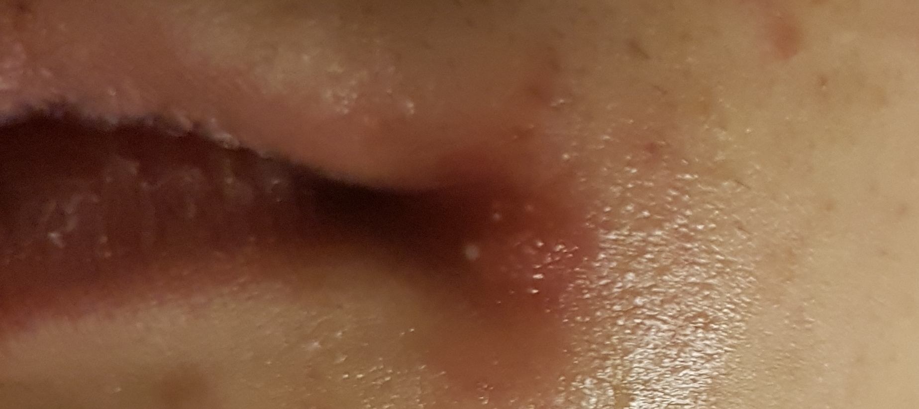 13+ Pickel An Der Lippe Kleinkind Images